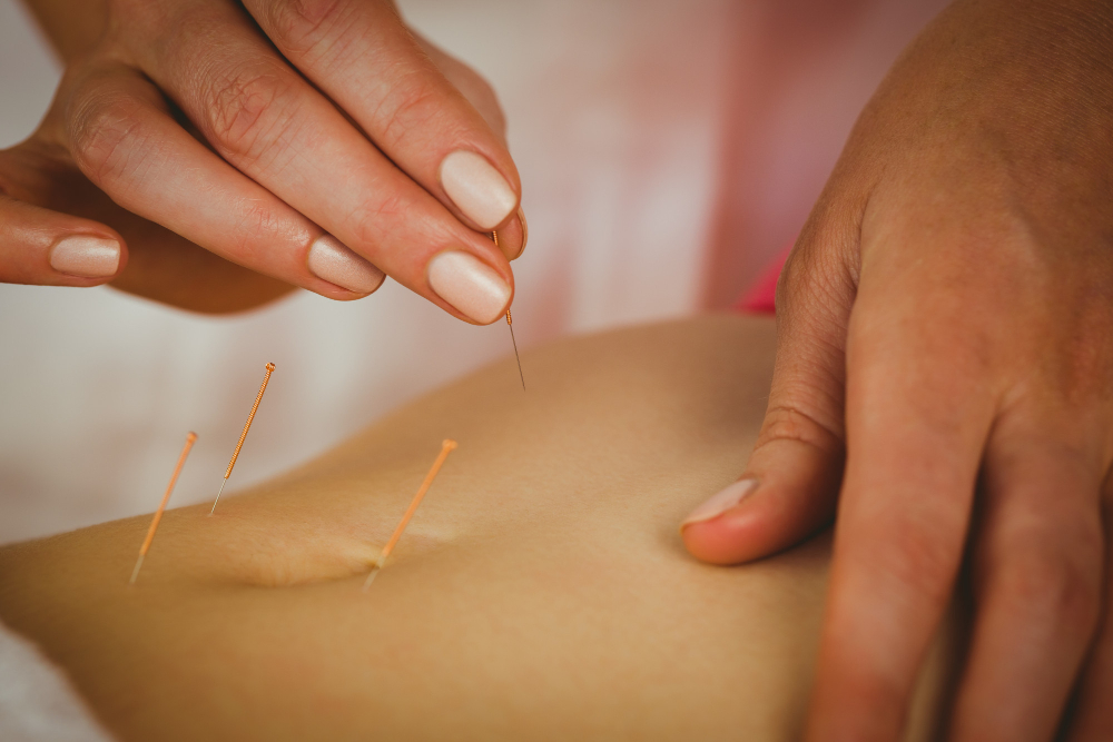 Acupuncture Treatment