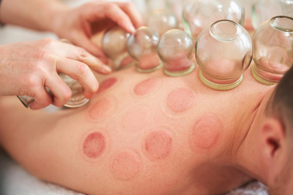 Cupping